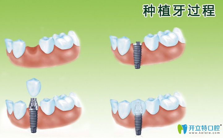 衡水口腔解答：單顆牙種植后會出現(xiàn)松動嗎