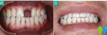 石家莊三博口腔種植牙前后效果圖 石家莊三博口腔種植牙前后效果圖