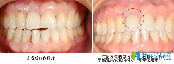 種植牙修復(fù)術(shù)后案例