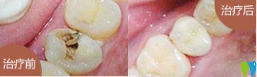 小白兔口腔兒童齲齒治療效果