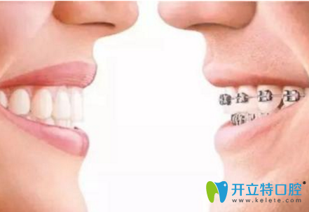 兒童用隱形牙套和傳統(tǒng)牙套哪個(gè)效果好？