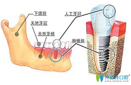 種植牙多少錢？哪些因素影響種植牙每一顆的價(jià)格？