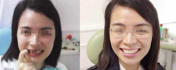 渭南小白兔口腔齙牙隱形矯正和牙齒缺損修復效果案例