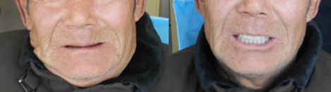 徐州博愛口腔牙科醫(yī)生為71歲老人進行全口活動義齒修復