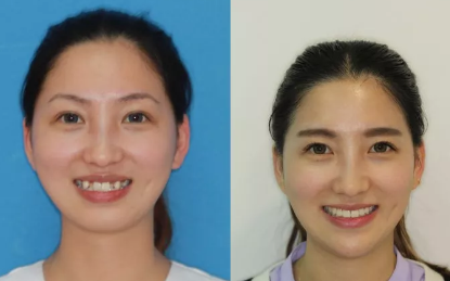 西安雁塔海濤口腔做的牙齒矯正手術(shù)，講講我有多痛苦