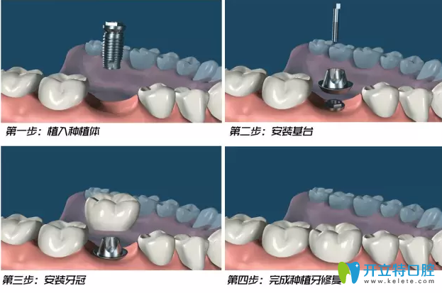 郴州植貝爾口腔種植牙過程