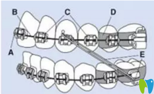 徐州博愛口腔牙齒矯正示意圖