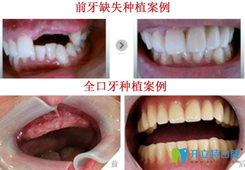 晉中潤(rùn)芽口腔<!--<i data=20240703-sp></i>-->種植牙好嗎？看<!--<i data=20240703-sp></i>-->種植牙案例對(duì)比圖