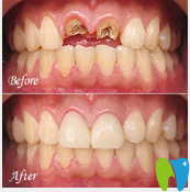 廣州暨博口腔潘廣嗣門牙顆牙缺失種植案例對比圖