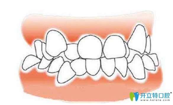 牙齒擁擠怎么矯正？一定要拔牙才能矯正嗎？
