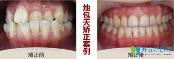 地包天牙齒矯正前后對比圖