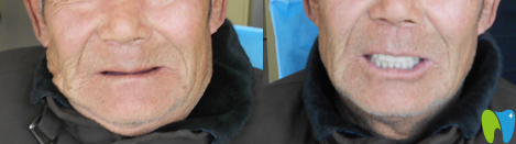 徐州博愛口腔全口活動(dòng)義齒修復(fù)案例前后效果