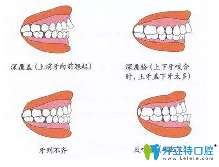 徐州博愛口腔暑期正畸優(yōu)惠開始啦