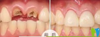 <!--<i data=20240703-sp></i>-->口腔做門牙缺失種植牙修復