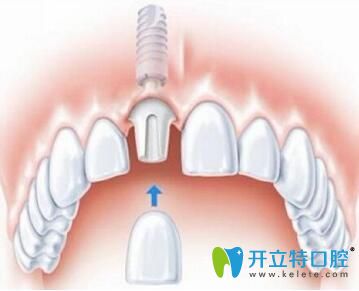 <!--<i data=20240703-sp></i>-->口腔做種植牙