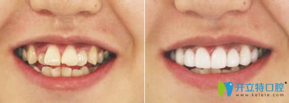 撫順牙齒矯正哪家醫(yī)院好，先來看下瑞德口腔的正畸案例吧