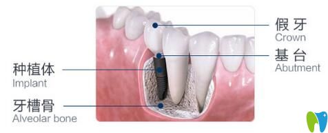 長沙好牙依口腔牙齒種植原理