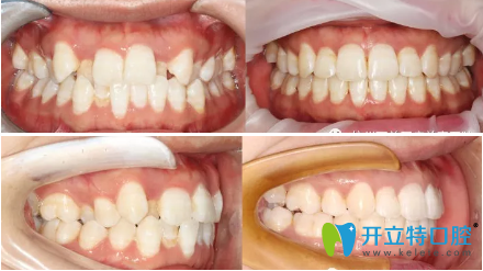 這是我手術前和手術后的牙齒照片對比圖