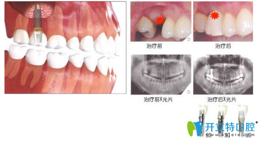 巴彥淖爾瑞欣口腔資深牙醫(yī)良心告白：種植牙并非鑲牙