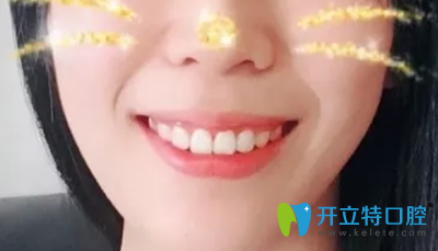 牙齒中度擁擠矯正后9個月恢復(fù)效果