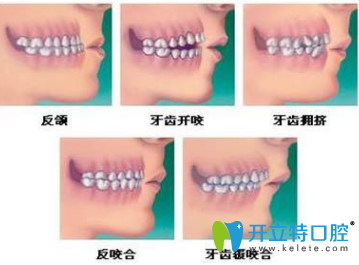 兒童矯正牙齒有哪幾個(gè)年齡段？有幾種矯牙齒的方法？
