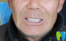 徐州博愛口腔全口活動(dòng)義齒修復(fù)后照片