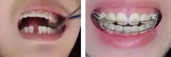 門牙缺失、齙牙怎么辦 看孝感口腔牙齒種植和矯正案例