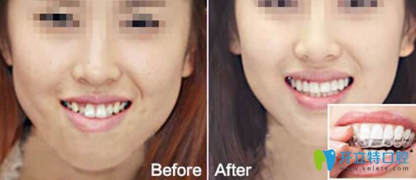 時(shí)代天使隱形牙齒正畸前對比圖