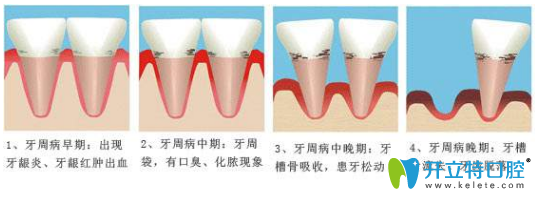牙周炎的過(guò)程