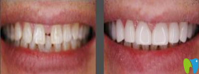 洛陽(yáng)維樂(lè)口腔牙齒縫隙過(guò)大矯正效果