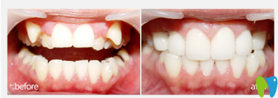 洛陽(yáng)維樂(lè)口腔虎牙矯正效果