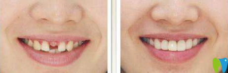 廈門宏沅膛口腔許保春種植牙效果對比圖