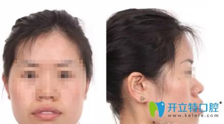 西安小白兔口腔做的牙齒矯正手術(shù)，忍受非一般的痛苦