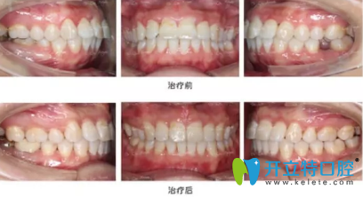 完全恢復(fù)之后我簡直很開心，牙齒就這么完美了