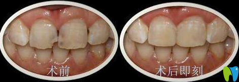 廈門宏沅膛謝良偉前牙美容性修復(fù)效果對比圖 廈門宏沅膛謝良偉前牙美容性修復(fù)效果對比圖