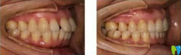 王立安醫(yī)師前牙前凸矯正案例