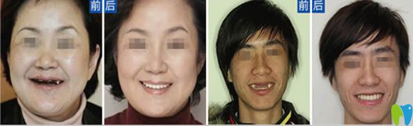 河源拜博種植牙前后對比效果