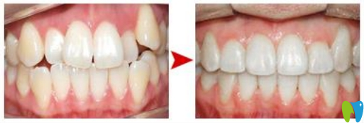 廈門宏沅膛陳少杰牙齒矯正效果對(duì)比圖
