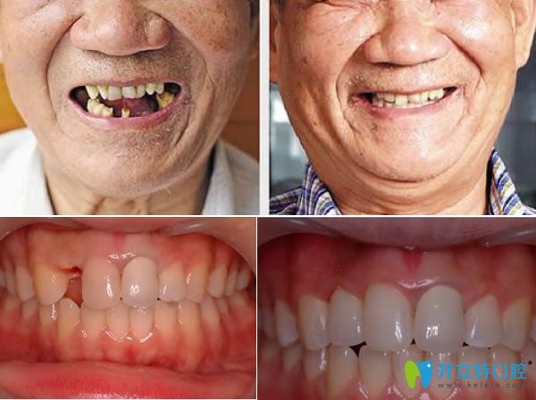 長春拜博口腔種植牙真人案例