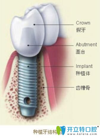 低價位的種植牙要警惕！