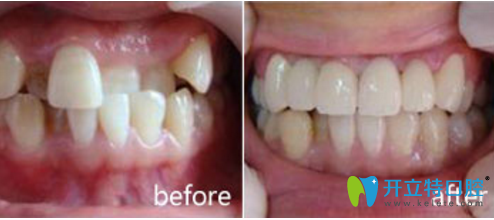 洛陽(yáng)維樂(lè)口腔牙齒擁擠矯正效果