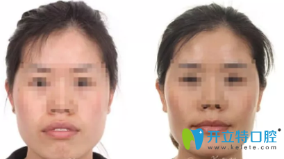 做了牙齒后就像是整容了一樣啊