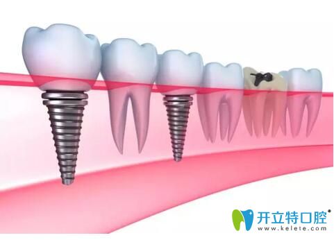 牙齒口腔種植方式