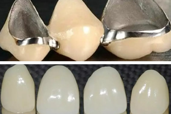 龍巖萬翔口腔分享 全瓷牙和烤瓷牙區(qū)別及全瓷牙價格多少錢