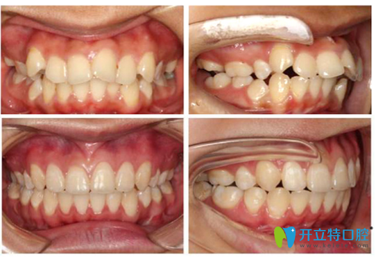 佛山拜博口腔王增全院長牙齒矯正案例對比圖