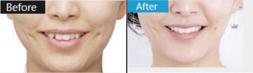 什么是數(shù)字化矯正牙齒？烏魯木齊美奧口腔張翔做的牙齒矯