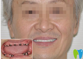 全口牙種植真人案例