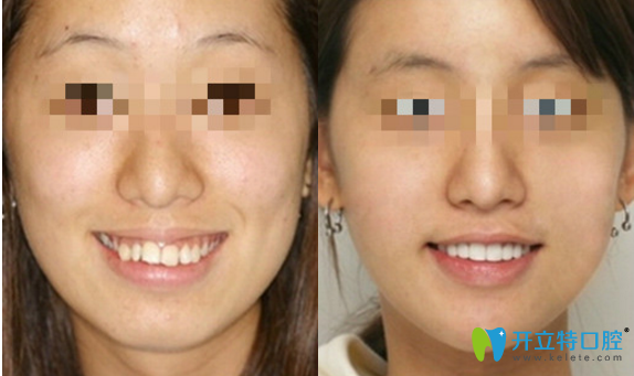牙齒矯正前后對比