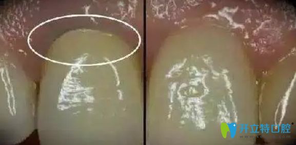 烤瓷牙使用久了容易引發(fā)口腔疾病