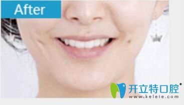 烏魯木齊美奧口腔張翔牙齒矯正真人案例術(shù)后照
